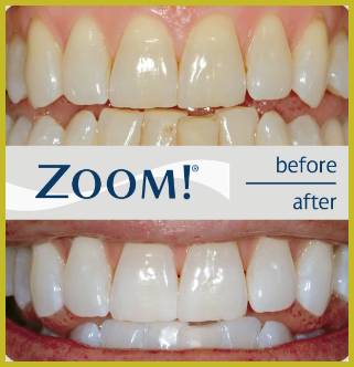 Zoom Teeth Whitening