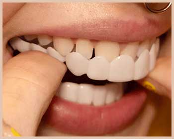 TruSmile Veneers
