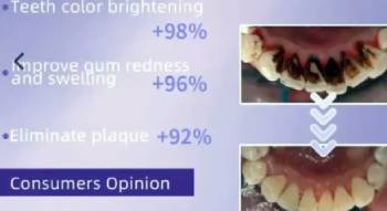 odalit teeth restoration powder